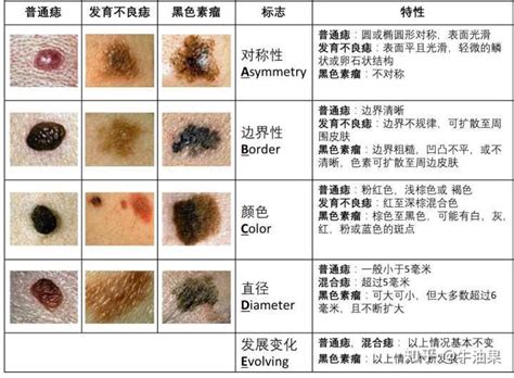 全身都是痣|身上长了黑痣就是黑色素瘤吗？该怎样判断？